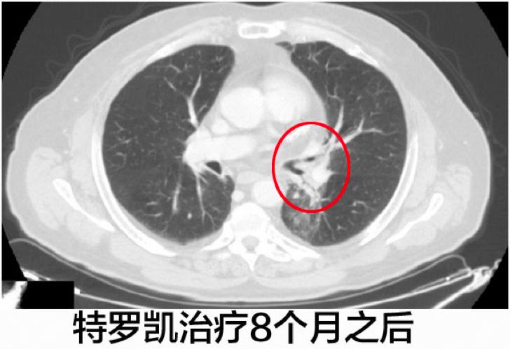 化疗失败后靶向药有效的案例,肺腺癌egfr突变耐药化疗