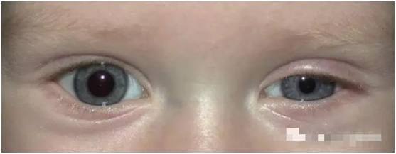 儿童神经母细胞瘤在腹部什么位置,2个月婴儿神经母细胞瘤