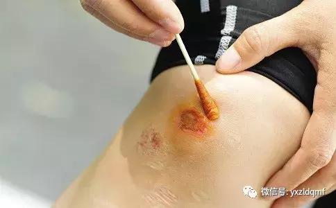 日常生活中外伤的止血方法