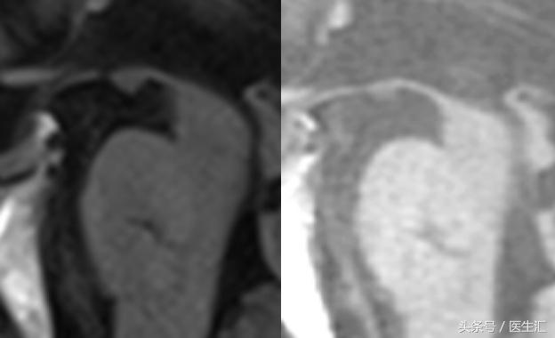 进行性核上性麻痹综合征,进行性核上性麻痹存活寿命
