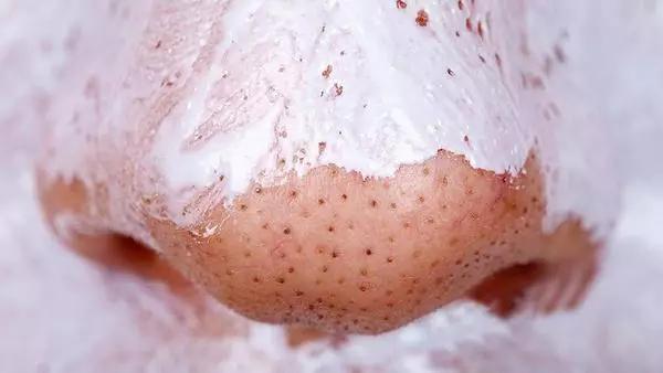 去黑头最彻底的偏方小妙招,去黑头的最好方法妙招科普