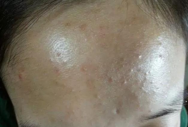 祛除白头粉刺涂阿达帕林,学生长白头粉刺怎么祛除