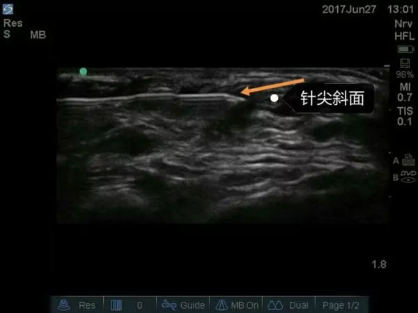 超声引导隐神经阻滞视频教学,超声引导下腰椎旁神经阻滞视频
