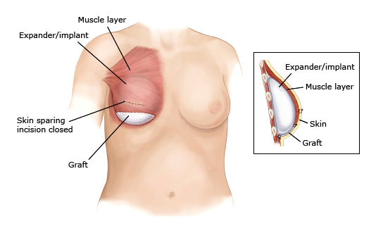 乳房全切和乳房重建能同时手术吗,乳房重建切口
