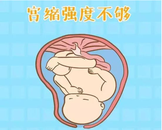 为什么现在生孩子要打催产素,遇到生孩子这个事应该怎么办