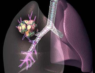 中央型肺癌骨转移,周围型肺癌骨转移