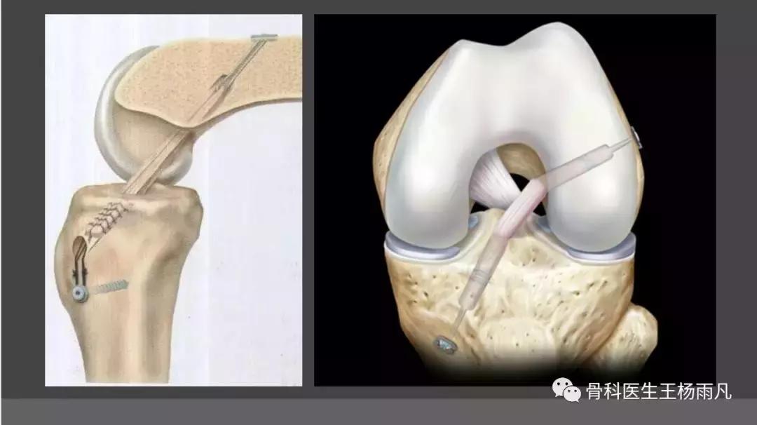 侧副韧带前叉断裂康复训练,前叉交叉韧带重建后多久能脱拐
