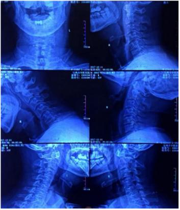 颈椎病压迫臂丛神经有哪些症状,颈椎病压迫神经引起面瘫怎么治疗