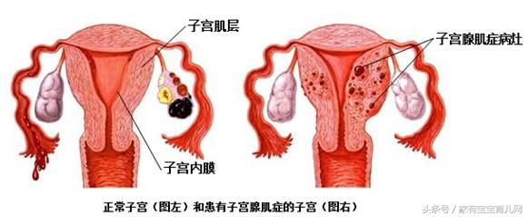 子宫破裂最主要的诱因是,怎么预防瘢痕子宫的破裂