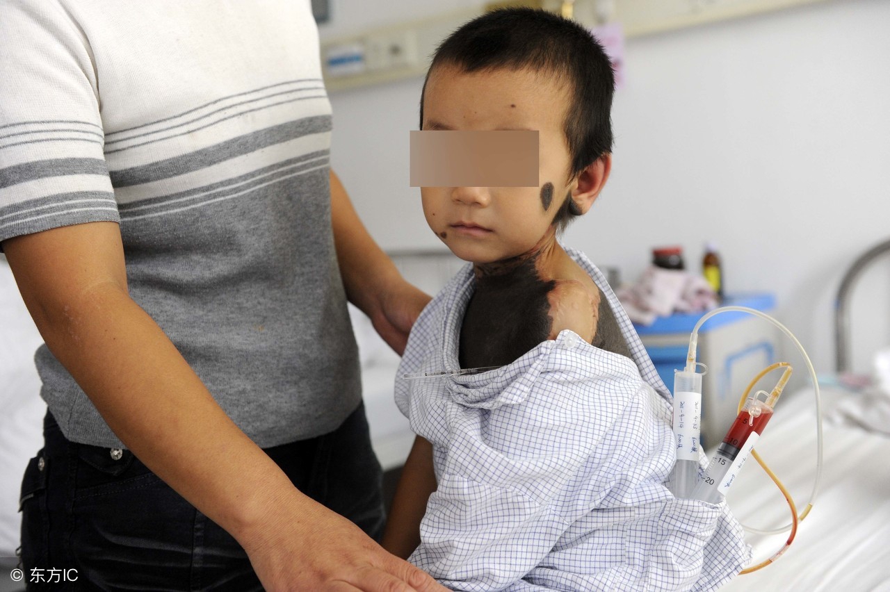 专家解读！血管瘤该怎么办？血管瘤会自行消退吗？