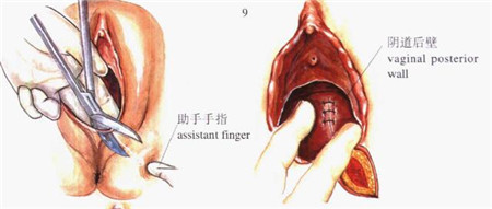 侧切应该多运动还是多休息,怎么可以提前避免侧切