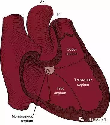 室缺与膜部瘤的区别,室缺自愈和假性膜部瘤的区别