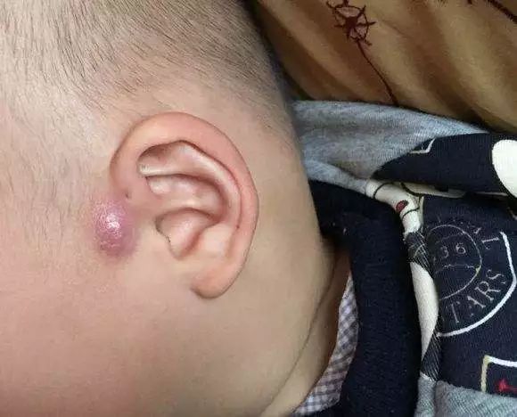 孩子耳朵长肉芽还流脓必须手术么,富贵包流血流脓是怎么回事