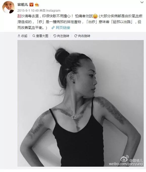 阿娇刮痧后背效果,阿娇背部刮痧图片