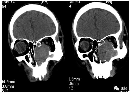 73岁患者无明显诱因出现左鼻塞、流脓涕，CT平扫发现密度影，怎么诊断？