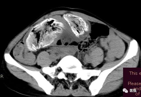 手术纱布遗留在体内可以吸收吗,手术纱布忘了取出会怎样