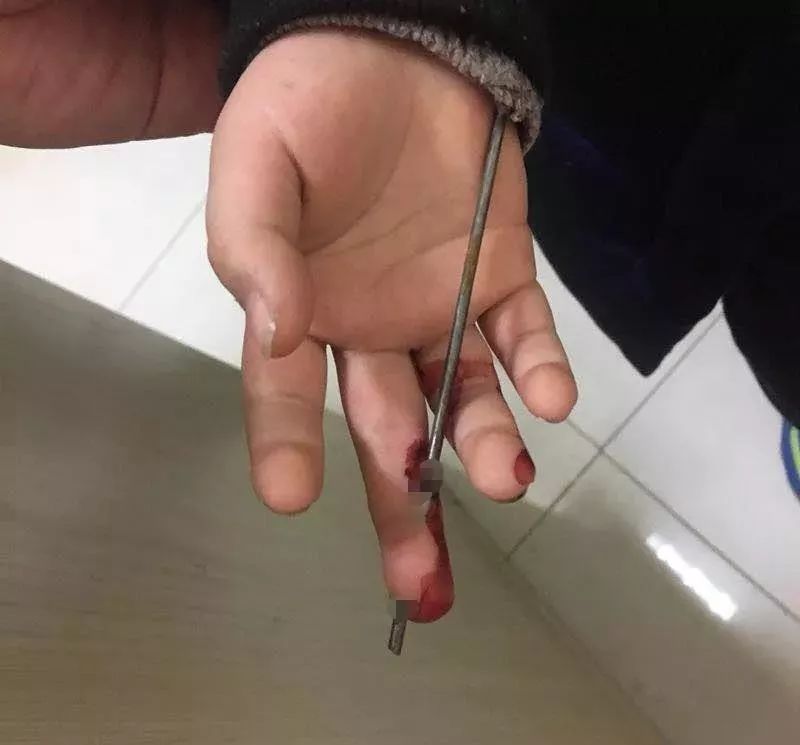 疼！家长们注意：熊孩子这样玩，钢丝刺穿右手中指！