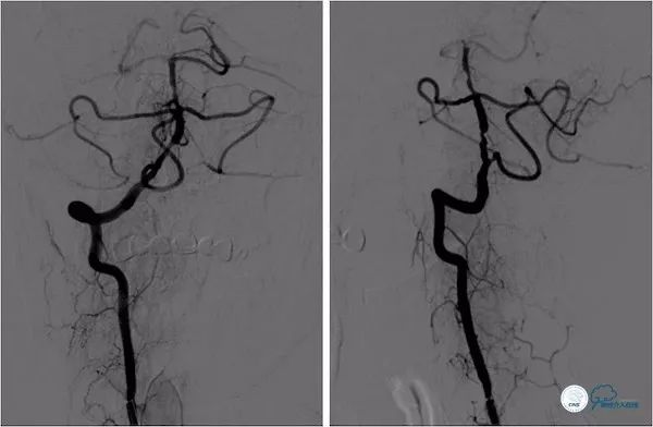 天坛医院做椎动脉狭窄多少要手术,天坛椎动脉狭窄