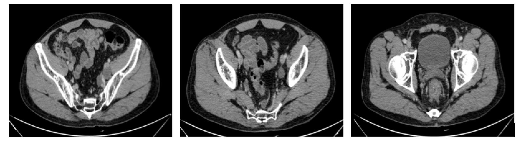 直肠腺癌肺转移最好的治疗方案,得了直肠腺癌不治疗能活几年
