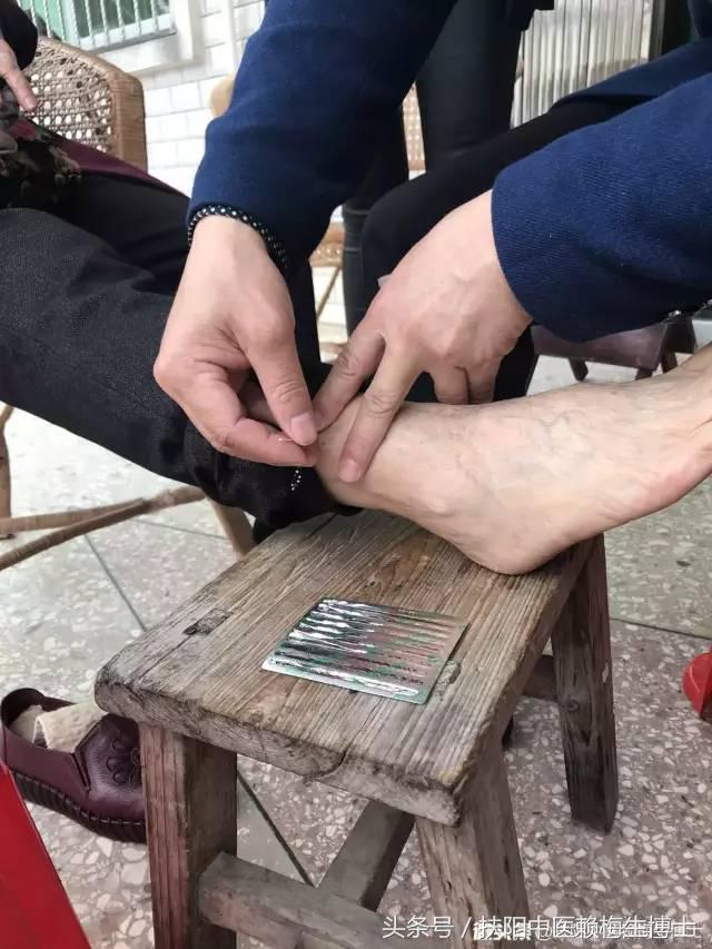 内针治疗带状疱疹剧烈疼痛4例分析