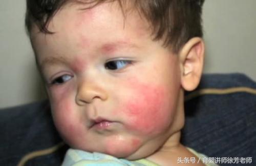 宝宝换了新奶粉身上起疙瘩,换奶粉后身上起红点点