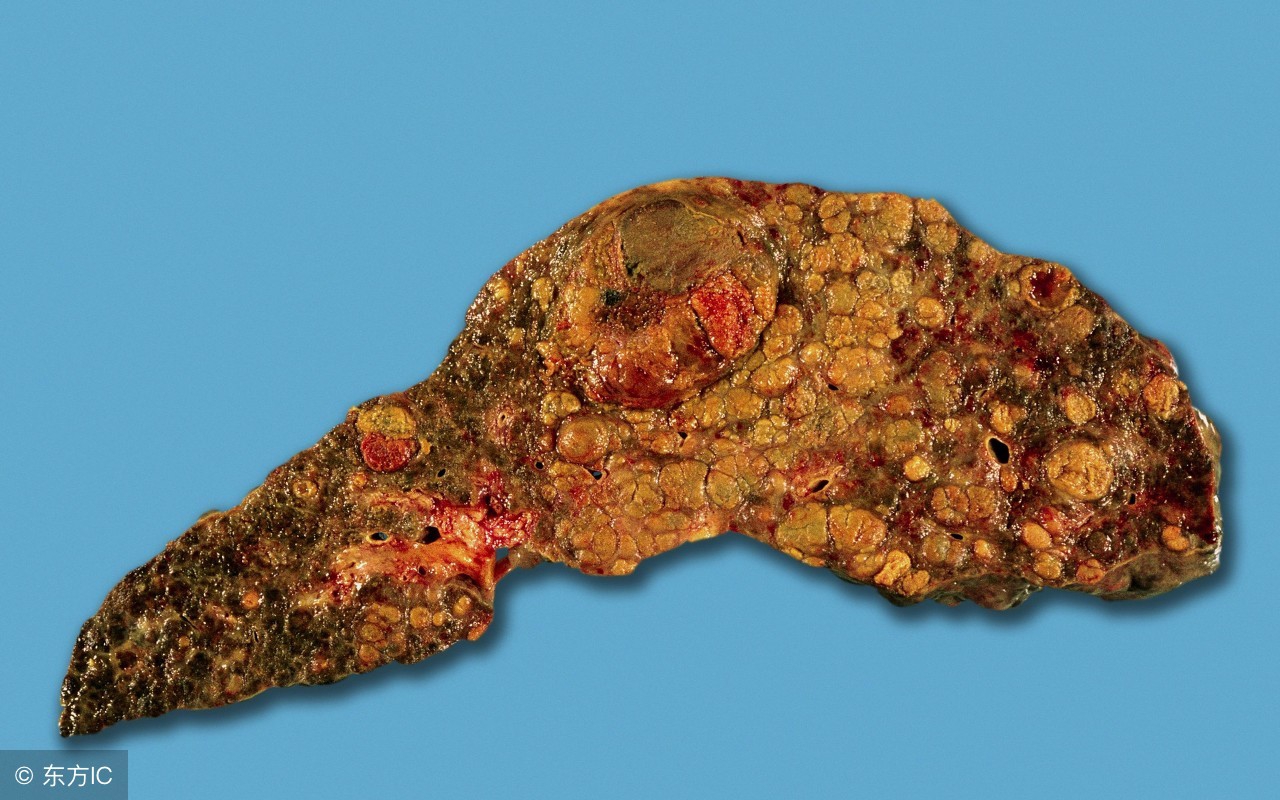 体检甲胎蛋白升高医院通知去复检,甲胎蛋白afp值高怎么办