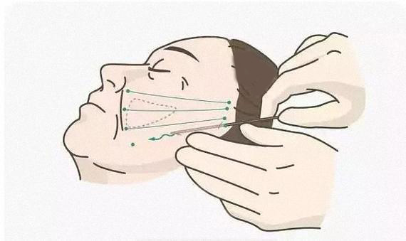 丰唇成香肠嘴视频,丰唇后像鸟嘴