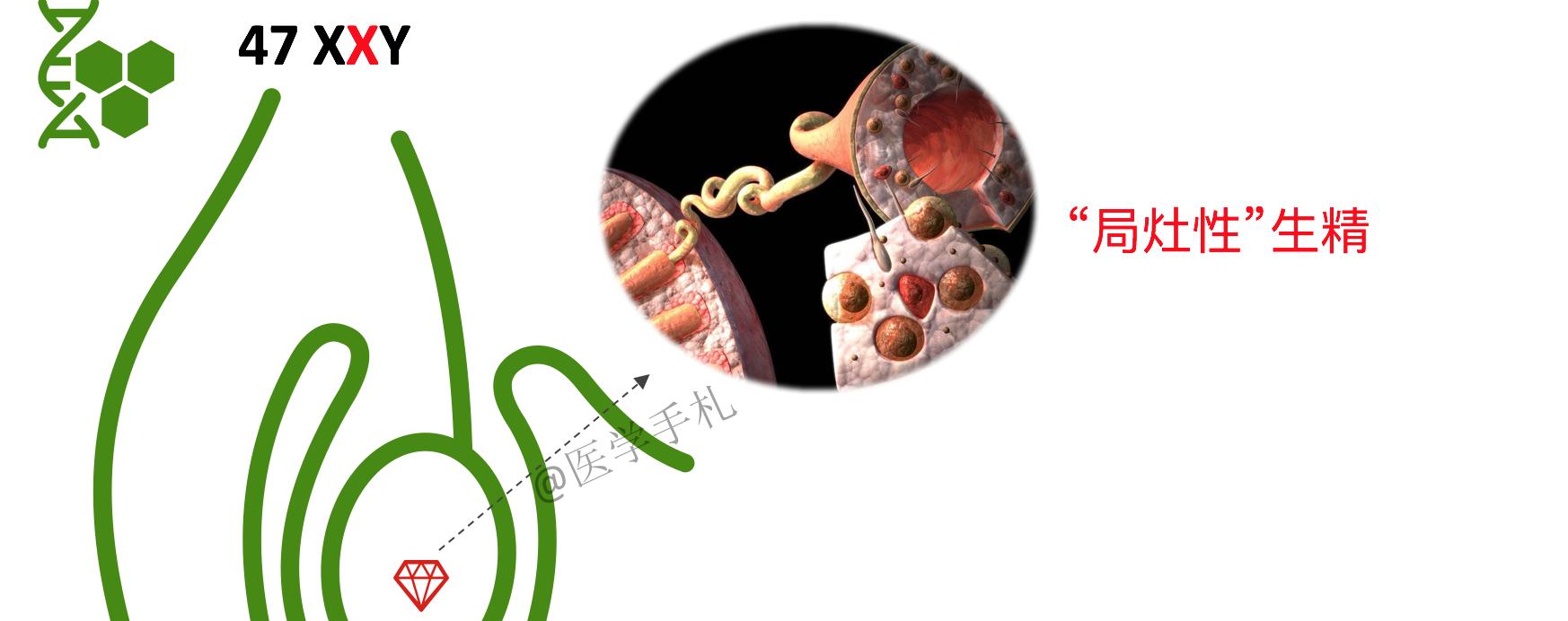 克氏综合征的人染色体会缺失吗,克氏综合征是染色体多吗