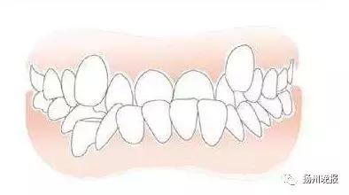 长出两排牙齿,6岁小孩并排长了两颗牙