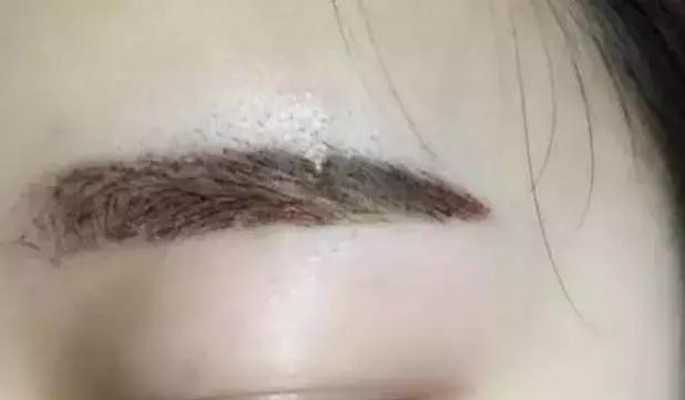 怎么让眉毛快速结痂掉痂,眉毛结痂掉痂修复过程