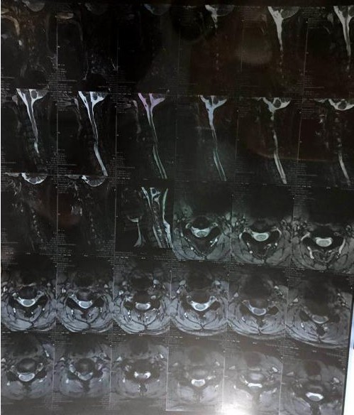 胳膊无力是什么类型的颈椎病,病人胳膊麻木没知觉怎么弄