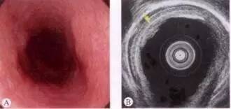 早期食管癌用内镜可以根除吗,超声内镜可以查出早期食管癌吗