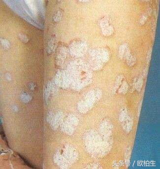 sc5b型紫外线光疗仪怎么样,紫外线光疗仪和308激光哪个好