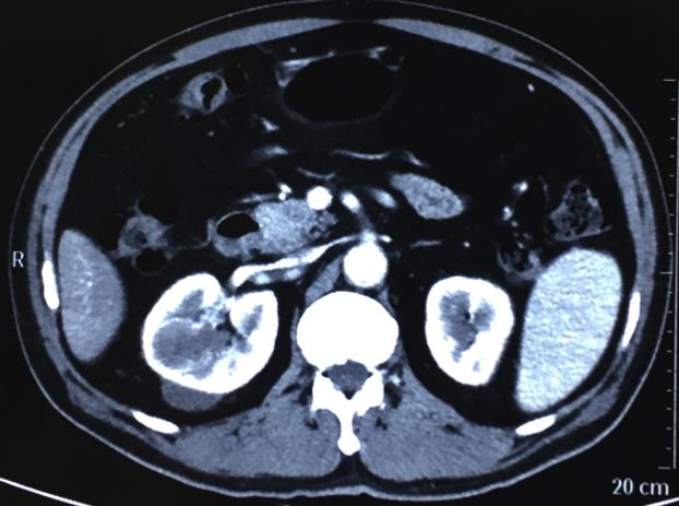 培唑帕尼和阿昔替尼哪个治肾癌好,阿昔替尼能治疗肾癌转移肝肺吗