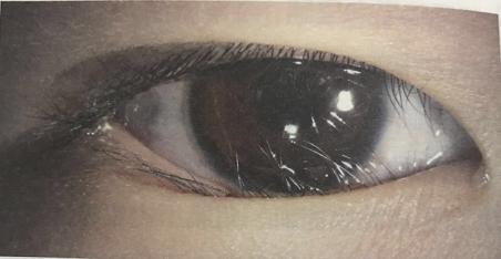 睫毛往眼睛里面长怎么回事,眼睫毛总是戳进眼睛为什么