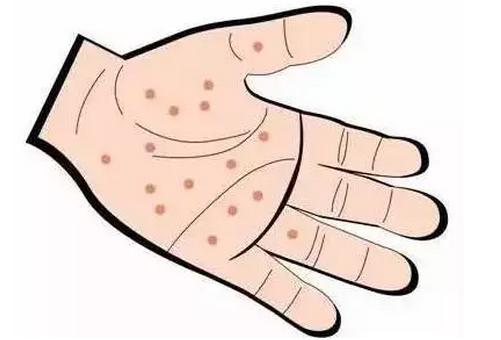 汗疱疹就长在一个手指头上,汗疱疹像针扎一样疼
