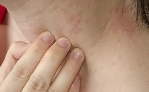 湿疹西医和中医一起治会效果好吗,痒湿疹怎么治疗