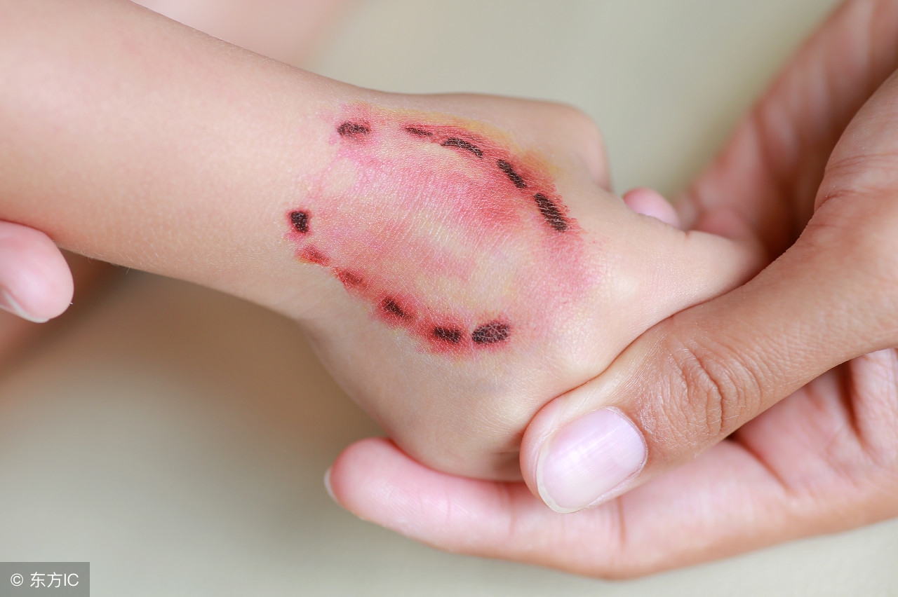 没得狂犬病的狗咬了要紧吗,没得狂犬病的猫被挠了要紧吗