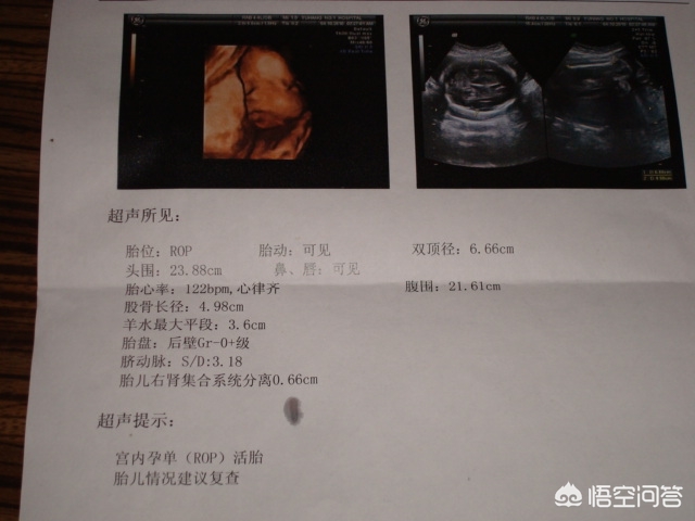 孕妈妈b超检查的全过程,教你读懂产检b超单