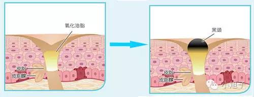 顽固草莓鼻怎么改善,消除草莓鼻的最快方法美容院