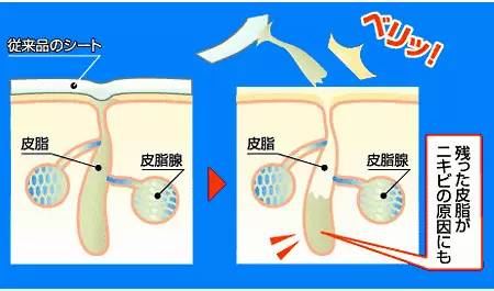 顽固草莓鼻怎么改善,消除草莓鼻的最快方法美容院