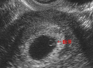 孕妈b超单怎么看,如何看懂b超影像里哪个是胎儿