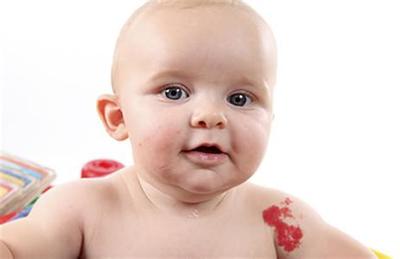 天使之吻红斑消退,天使之吻胎记怎么治疗