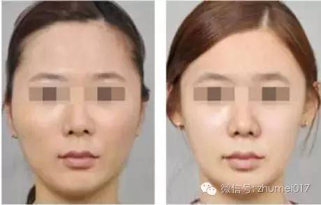 脸上部分凹陷,年龄增长脸颊凹陷