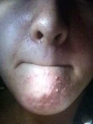 白头粉刺和白头闭口有什么区别,白头丘疹和白头粉刺区别