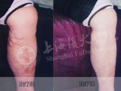 舌静脉曲张的症状及危害,外阴静脉曲张有什么症状