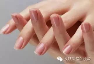 以为是灰指甲结果指甲掉了,得了灰指甲不管它行吗