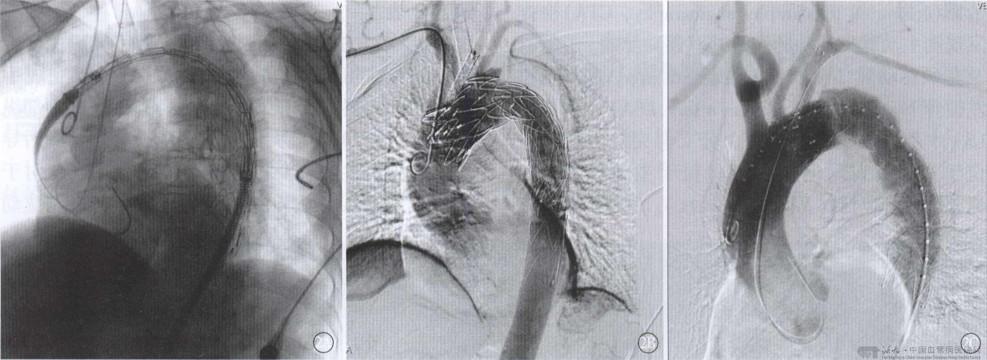 美国治疗主动脉夹层,倪海厦治疗主动脉夹层