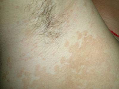 妙治汗斑的实用配方