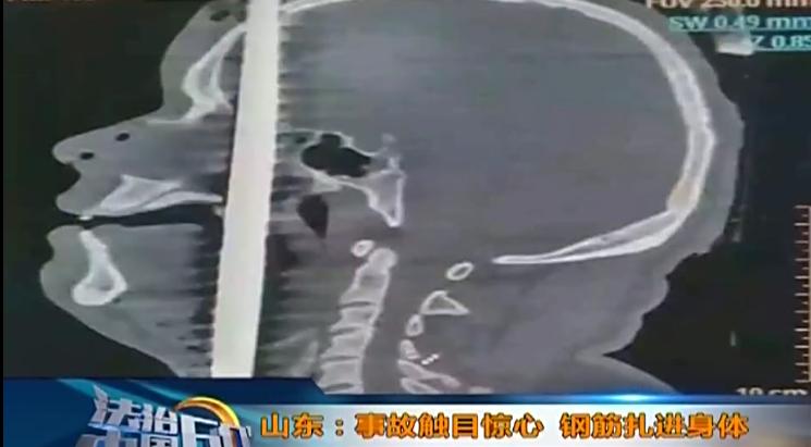 扎钢筋突发事故,钢筋工事故案例警示视频